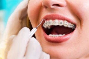 Close-up of hands applying orthodontic wax to a broken wire on dental braces.